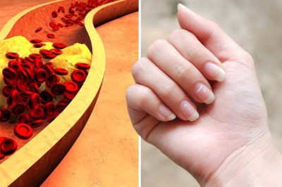 7 Dấu Hiệu Bàn Tay Báo Hiệu Cholesterol Cao Ở Nam Giới