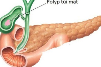 Hiểu Biết Về Polyp Túi Mật: Nguyên Nhân, Triệu Chứng và Cách Điều Trị
