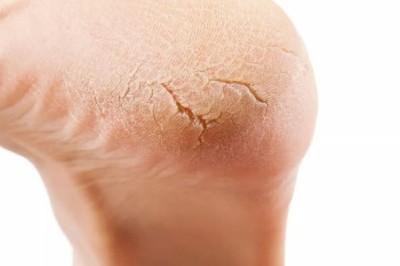 Soi Bàn Chân Mà Thấy Dấu Hiệu Này, Cẩn Thận Gan Suy Hỏng, Mất Chức Năng Từ Bao Giờ