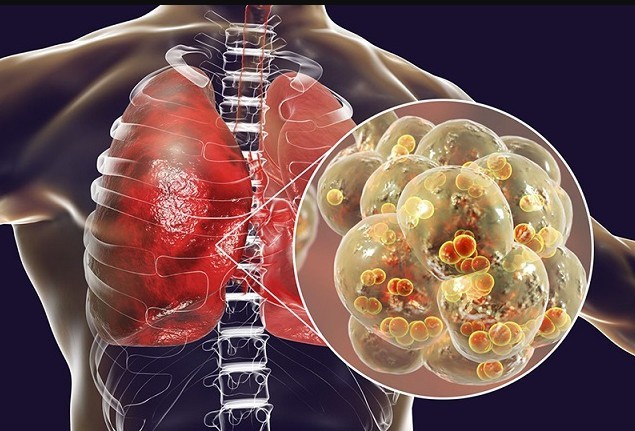 Cách thức SARS-CoV-2 tấn công phổi
