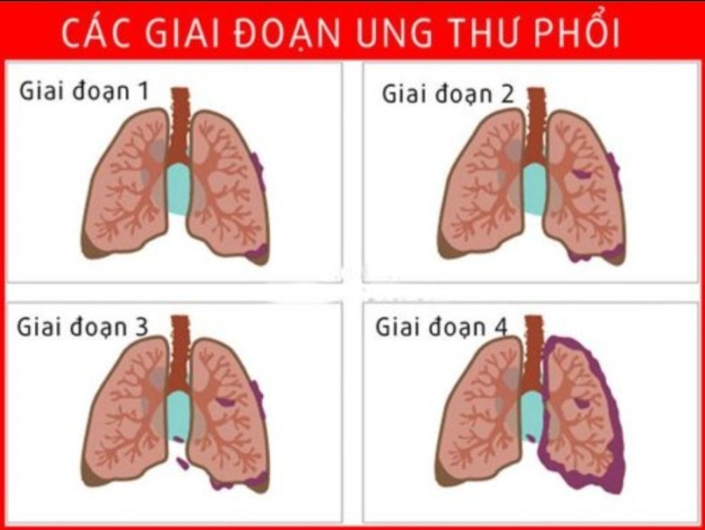 Các dấu hiệu khác của ung thư phổi