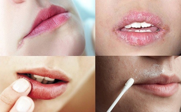 1.Chốc mép là gì?