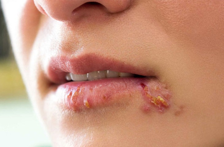 2. Điều trị chốc mép