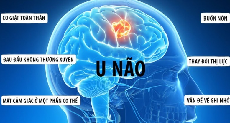 Dấu hiệu u não ở trẻ em