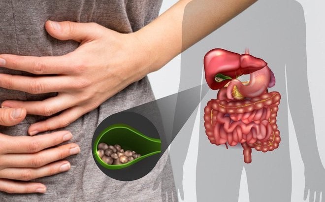 1. Polyp túi mật là gì? Tại sao có polyp túi mật?