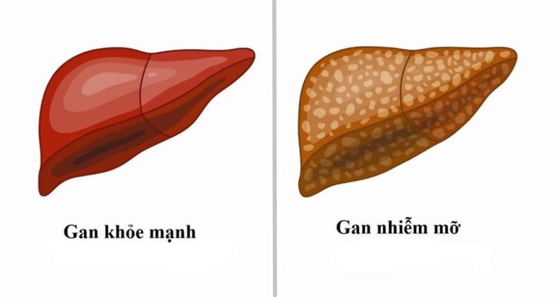 Cách sử dụng cỏ nhọ nồi ở người bệnh gan nhiễm mỡ