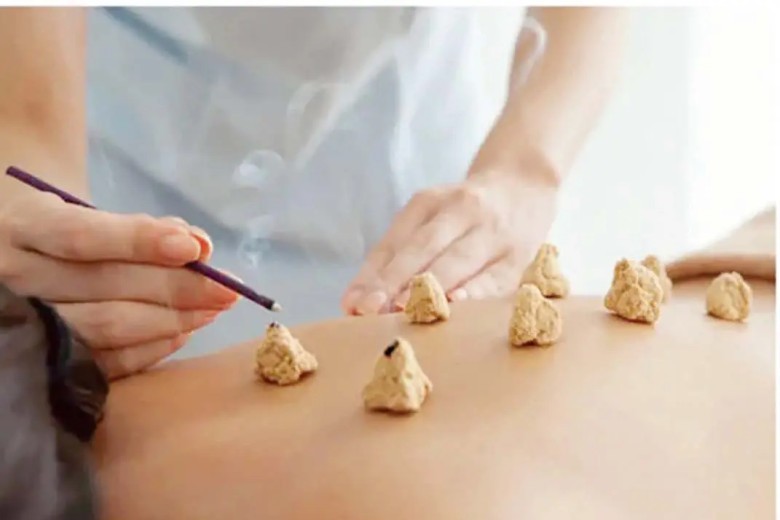 Châm cứu bấm huyệt có lịch sử hàng nghìn năm
