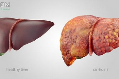 Vì sao phải giải độc gan, Đâu là thuốc bổ gan, giải độc gan, Khi nào cần dùng thuốc
