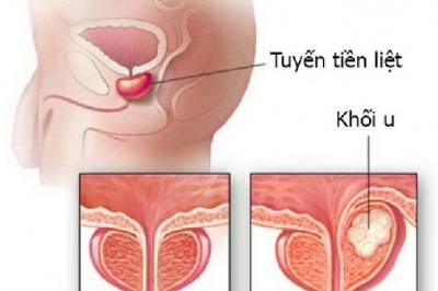 Các giai đoạn của bệnh ung thư tiền liệt tuyến