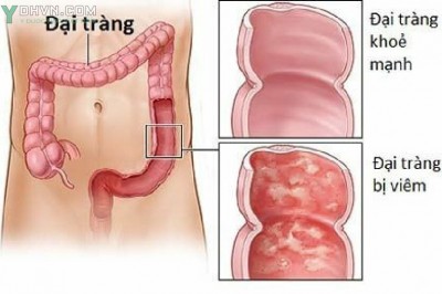 Những thực phẩm tốt và không tốt cho người bị bệnh viêm đại tràng mãn tính