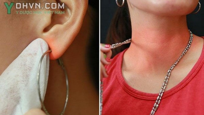 Khắc phục tình trạng dị ứng da do đeo trang sức kim loại
