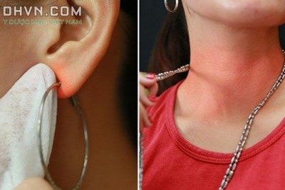 Khắc phục tình trạng dị ứng da do đeo trang sức kim loại