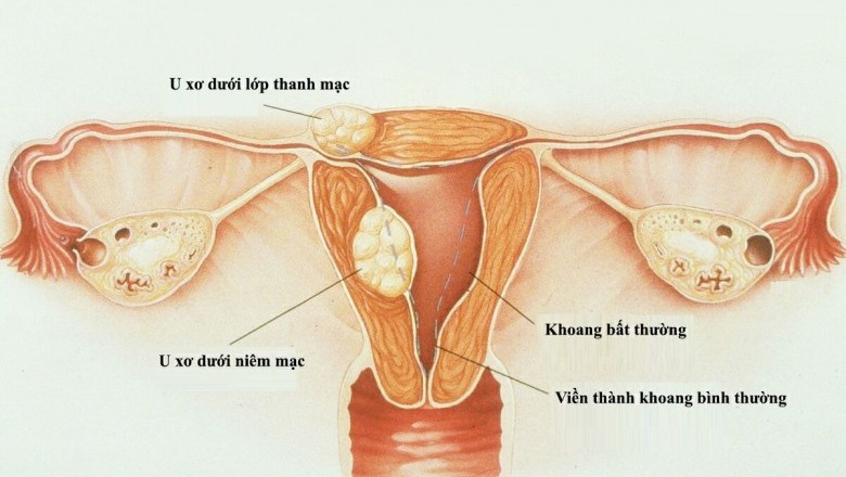 Chẩn đoán và điều trị bệnh u xơ tử cung hiệu quả