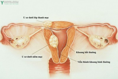 Chẩn đoán và điều trị bệnh u xơ tử cung hiệu quả