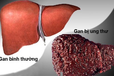 Phát hiện protein mới chống ung thư gan