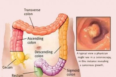 Vì sao nhiều người trong một nhà cùng bị ung thư đại trực tràng: theo Tiến sĩ Phạm Văn Bình