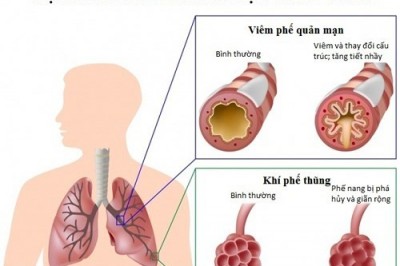 Hỗ trợ trị hen phế quản, hen suyễn, COPD theo đông y gia truyền 500 năm