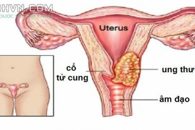 Bệnh Ung thư cổ tử cung là gì?