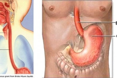 Bệnh Viêm thực quản là gì, bệnh có nguy hiểm không