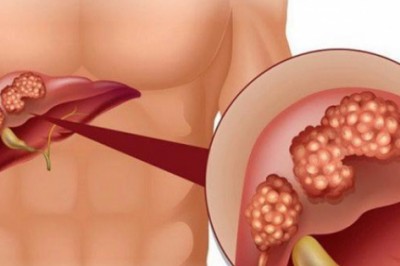 Dấu hiệu ung thư gan và các giai đoạn nhất định bạn phải biết