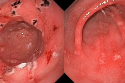 Viêm dạ dày lâu ngày có thể dẫn tới ung thư: Phát hiện và chữa kịp thời nhờ 8 dấu hiệu