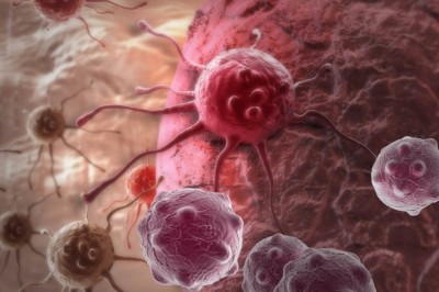 Trí tuệ nhân tạo của Google có thể phát hiện ung thư vú di căn hiệu quả hơn bác sĩ