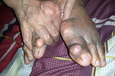 Những bài thuốc đông y chữa bệnh gút