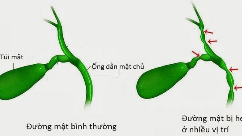 Dấu hiệu nhận biết bệnh teo đường mật bẩm sinh tránh nhầm bệnh vàng da sinh lý, viêm gan