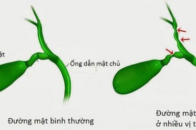 Dấu hiệu nhận biết bệnh teo đường mật bẩm sinh tránh nhầm bệnh vàng da sinh lý, viêm gan