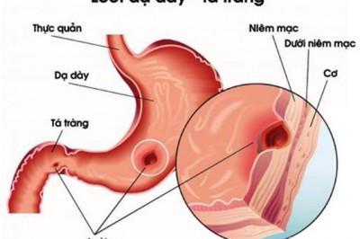 Thảo dược trị viêm dạ dày tá tràng từ cây Chè dây, cây Dạ cẩm, Bạch truật 