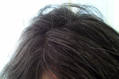 Bệnh tóc bạc sớm là gì? Xem thêm thực phẩm phòng bệnh Tóc Bạc Sớm