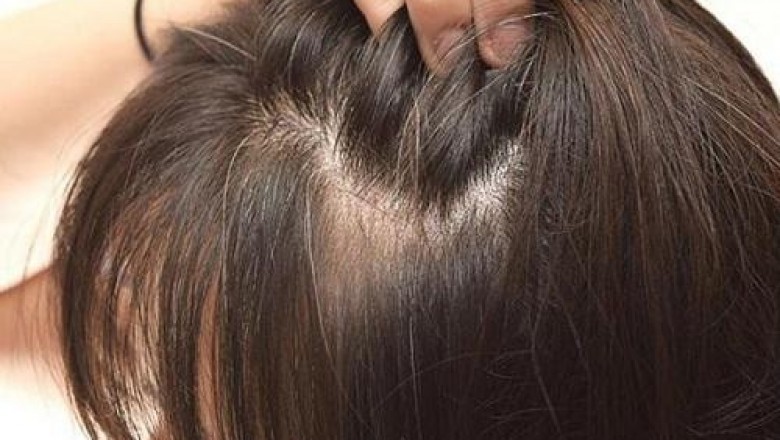 Tóc bạc sớm ở nữ giới là gì, nguyên nhân và cách trị tóc bạc sớm đơn giản tại nhà bằng Thảo dược