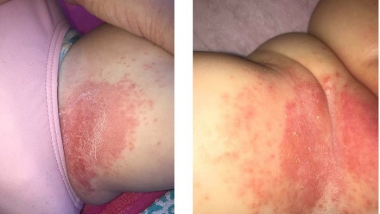 Hàng trăm bà mẹ yêu cầu thương hiệu Huggies thu hồi tã do gây bỏng cho trẻ