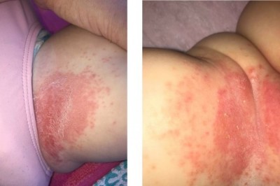 Hàng trăm bà mẹ yêu cầu thương hiệu Huggies thu hồi tã do gây bỏng cho trẻ