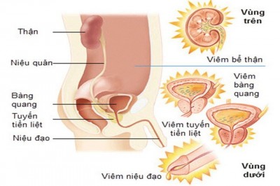 Dấu hiệu của viêm đường tiết niệu ở người lớn và trẻ em