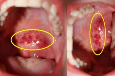 Bài thuốc trị viêm họng, thanh quản