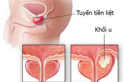 Dấu hiệu cảnh báo bạn bị ung thư tuyến tiền liệt