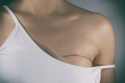 Tìm hiểu Ung thư tuyến Vú