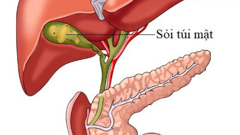 Sỏi mật, Triệu chứng, nguyên nhân, điều trị, phòng ngữa bệnh sỏi túi mật