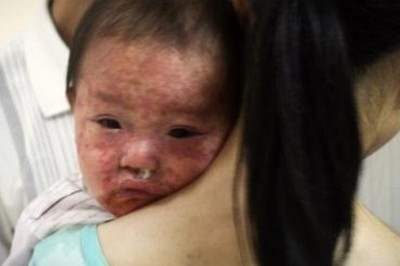 Bài thuốc nam hỗ trợ điều trị bệnh sởi