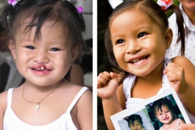 Chia sẻ: Caritas Sài Gòn tổ chức chương trình mổ sứt môi, hở hàm ếch cho trẻ em nghèo