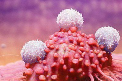 Nga tìm ra phương pháp mới xạ trị ung thư não