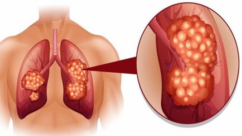 Cách dùng thảo dược, Món ăn bài thuốc chữa ung thư phổi