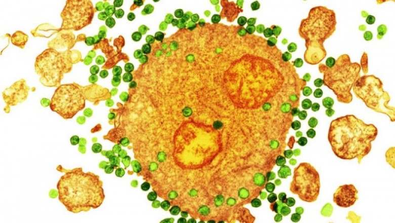 Bệnh nhân thứ hai trên thế giới được chữa khỏi HIV