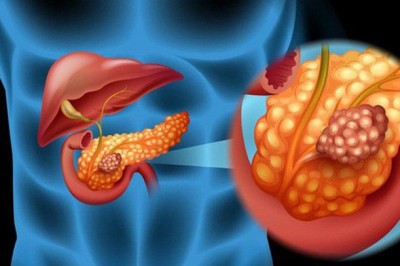Dấu hiệu nhận biết bệnh ung thư tụy là gì?