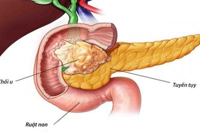 Vì sao mắc bệnh ung thư tụy khó chữa?