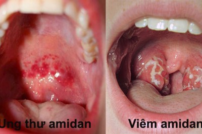 Làm thế nào để phân biệt ung thư amidan và viêm amidan?