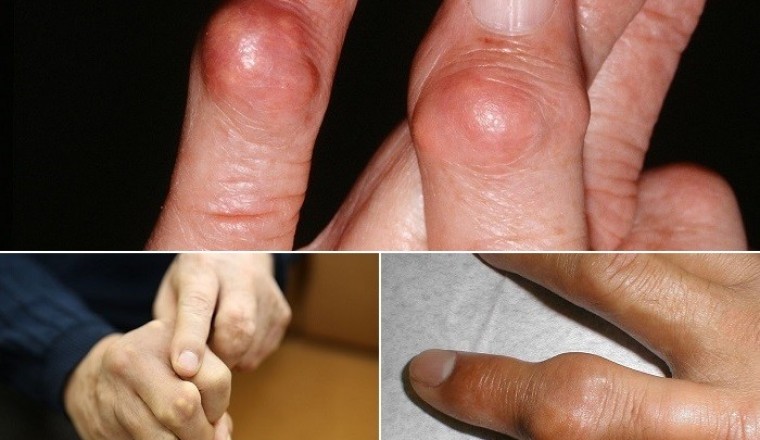 Người bệnh gút, kiêng ăn gì?