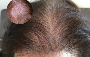 Món ăn, bài thuốc từ thảo dược trị rụng tóc