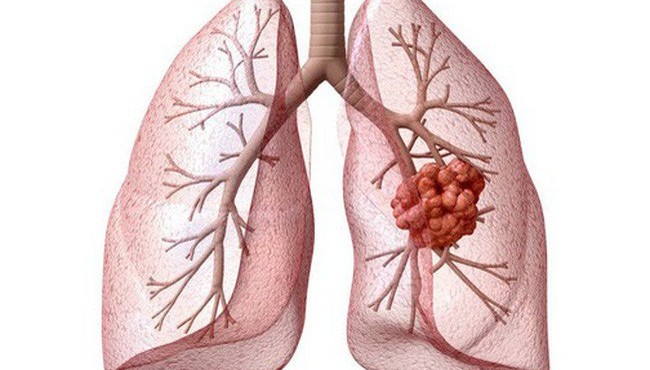 Tiềm năng mới trong điều trị ung thư phổi